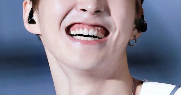 A gummy smile can be caused by genetics