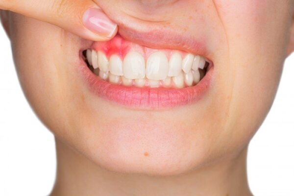 Is crown lengthening painful?