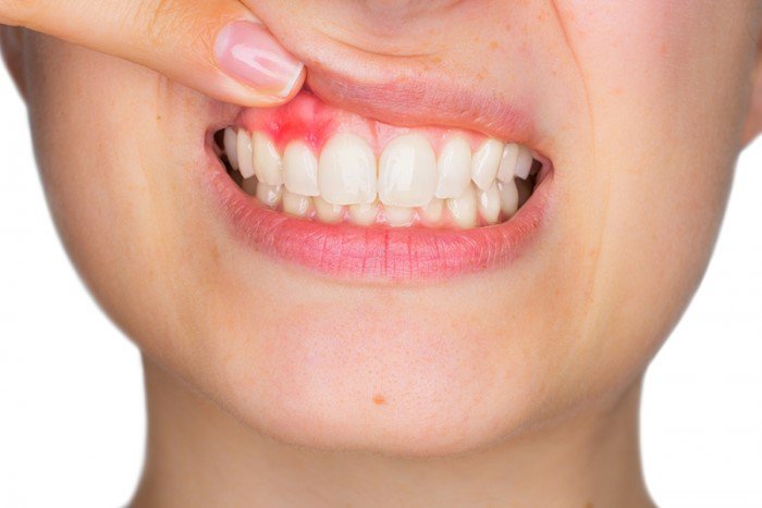 Is crown lengthening painful?