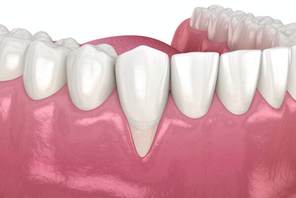 What factors determine the cost of crown lengthening?