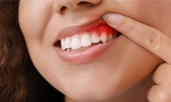 Platinum Dental is one of the most well-known places for crown lengthening