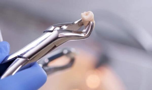 Wisdom tooth removal - Dental Clinic Vietnam Prices