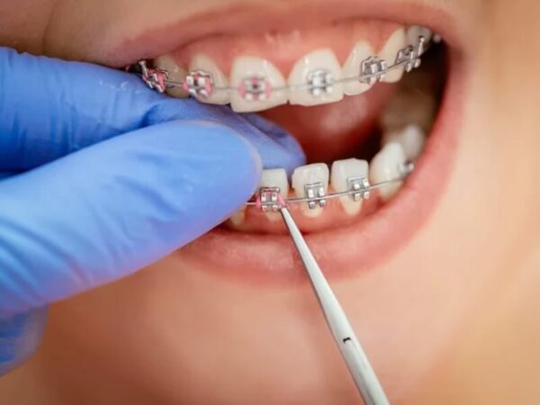 Braces - Dental Clinic Vietnam Prices