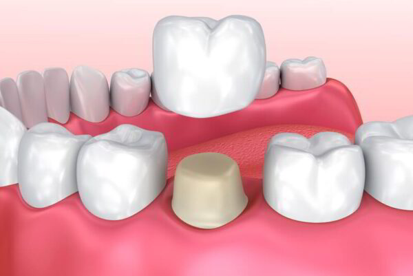 What are porcelain crowns? How many types of dental crown material are at Platinum Dental