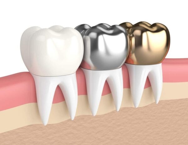 Structure of porcelain crown