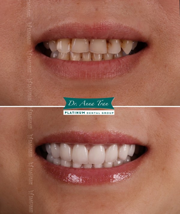 What is a dental crown?