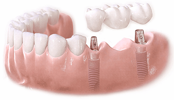 Titanium Implants