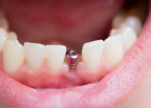 Dental Implants Titanium vs Zirconium: How to choose the best option?