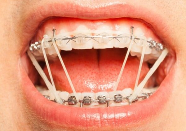 Lý do vì sao niềng răng cần đeo thun liên hàm