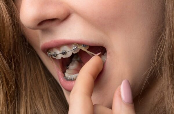 Hướng dẫn cách đeo thun liên hàm đúng chuẩn