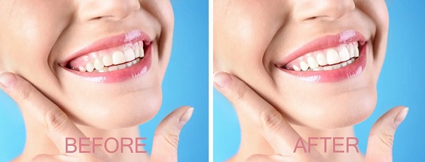 Consult your dentist or orthodontist about your problems if you're interested in fixing your gummy problems