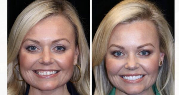 How much does a gummy smile treatment cost?