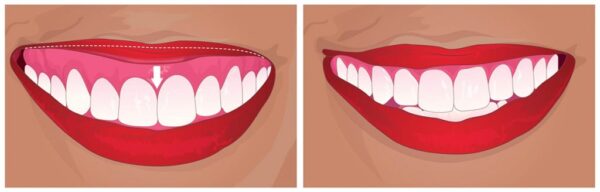 What is the procedure for gummy surgery?