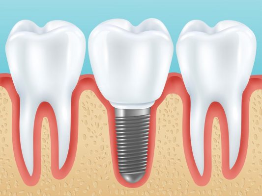 What are immediate implants after extraction?