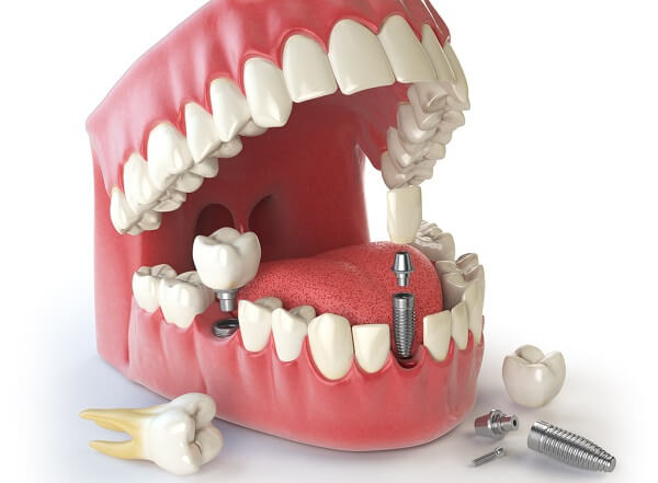 Is it possible to get an immediate implant after extraction?