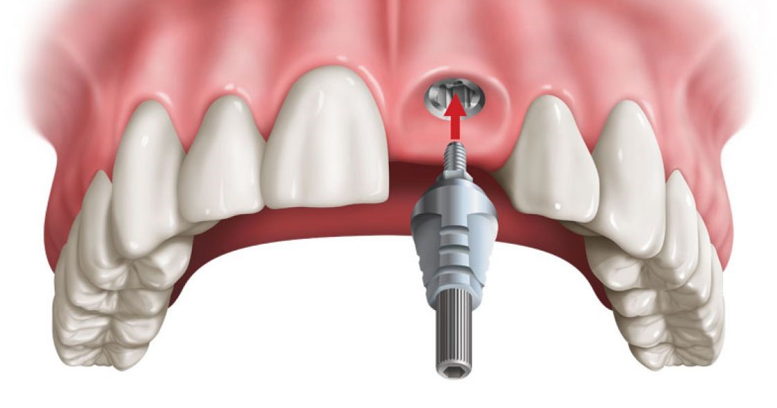 Mất bao lâu cho quá trình trồng implant răng cửa?