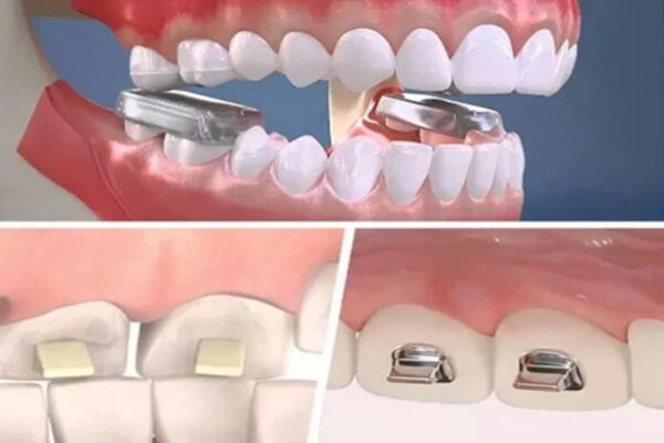 Nâng khớp cắn trong niềng răng