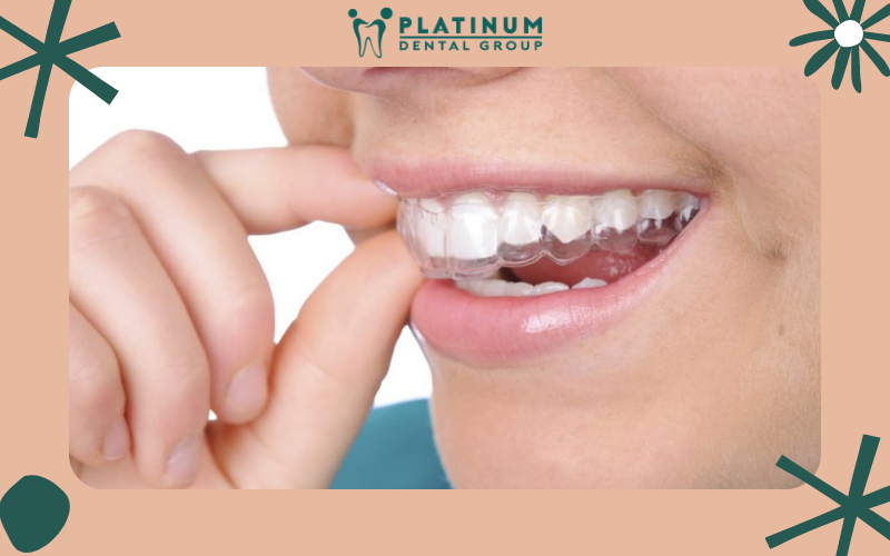 Trường hợp không cần nhổ răng khi niềng