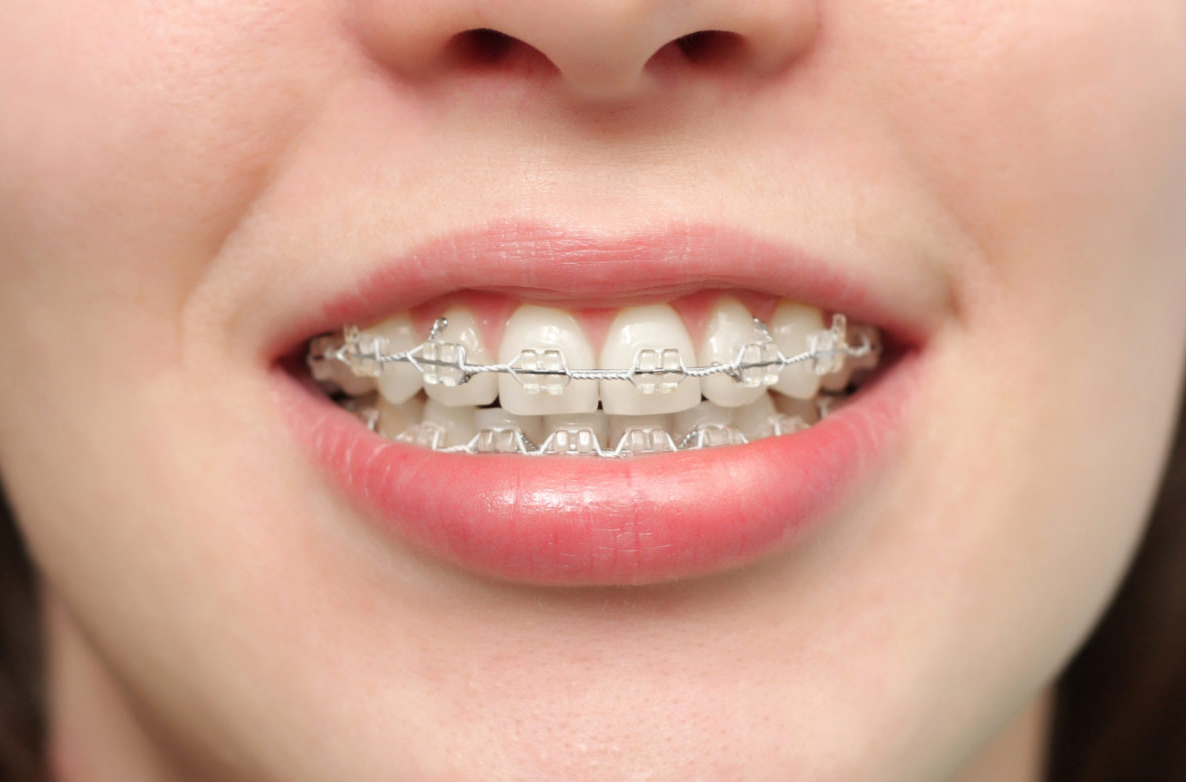 Các Loại Mắc Cài Niềng Răng