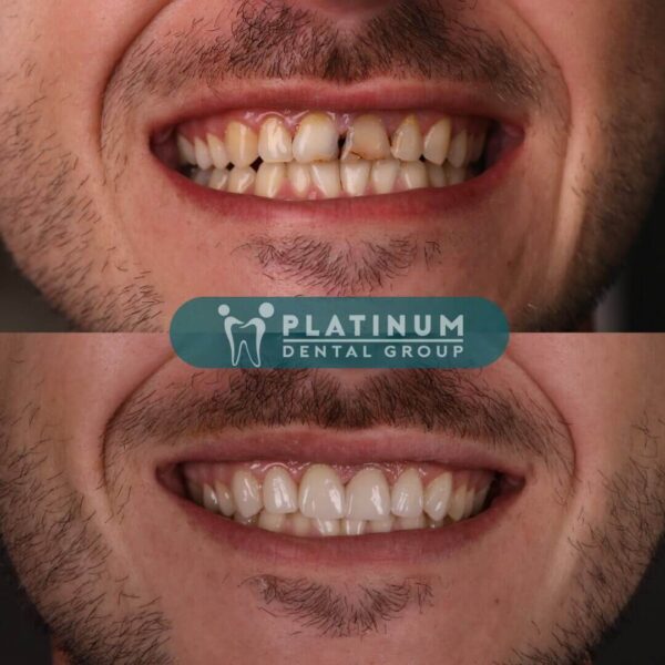 The best dental crown materials
