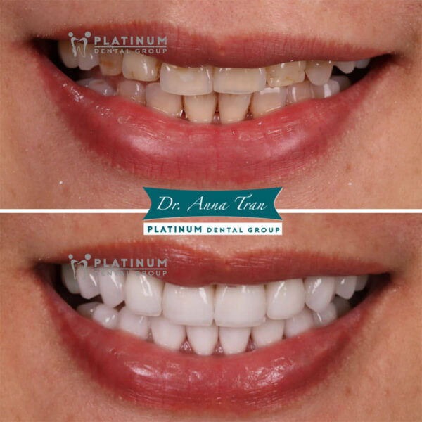 The best dental crown materials