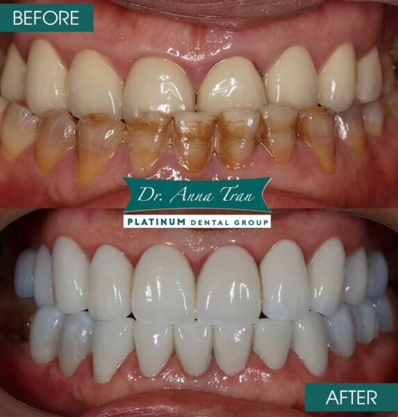 The best dental crown material