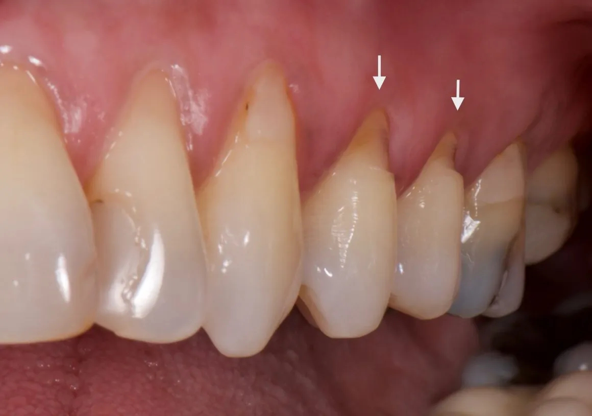 Các triệu chứng khi bị mòn cổ chân răng