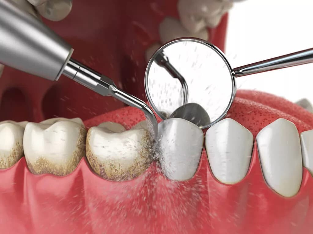 Điều trị viêm nướu như thế nào cho hiệu quả?