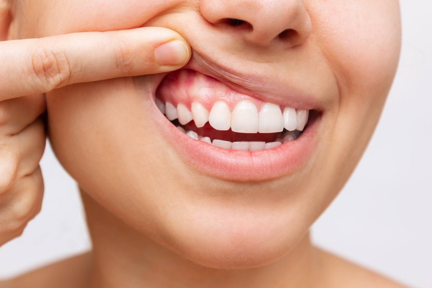 Làm sao để phòng tránh bị viêm nướu răng?