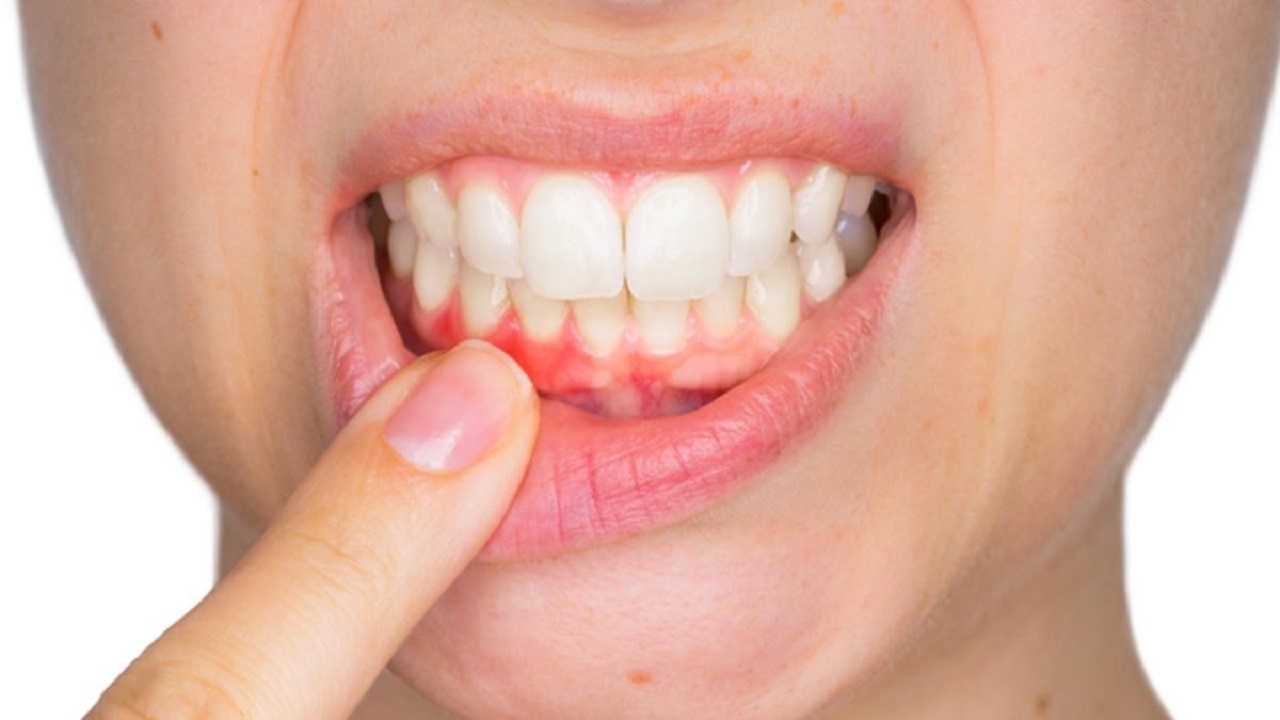 Dấu hiệu để dễ dàng nhận biết viêm nướu răng