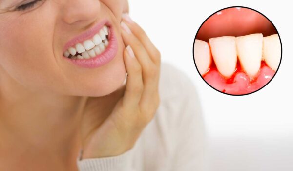 Lưu ý khi điều trị viêm chân răng