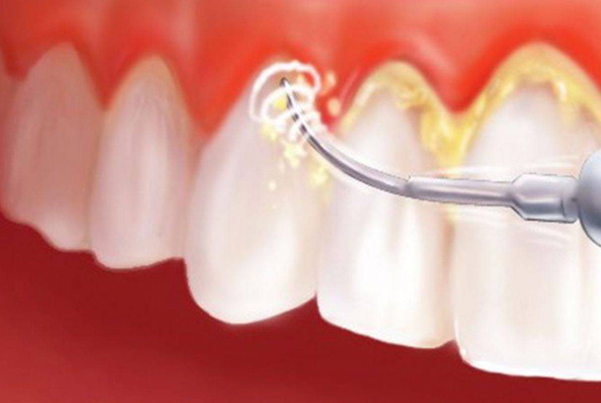 Phòng tránh bệnh lý về răng này như thế nào là hiệu quả ?