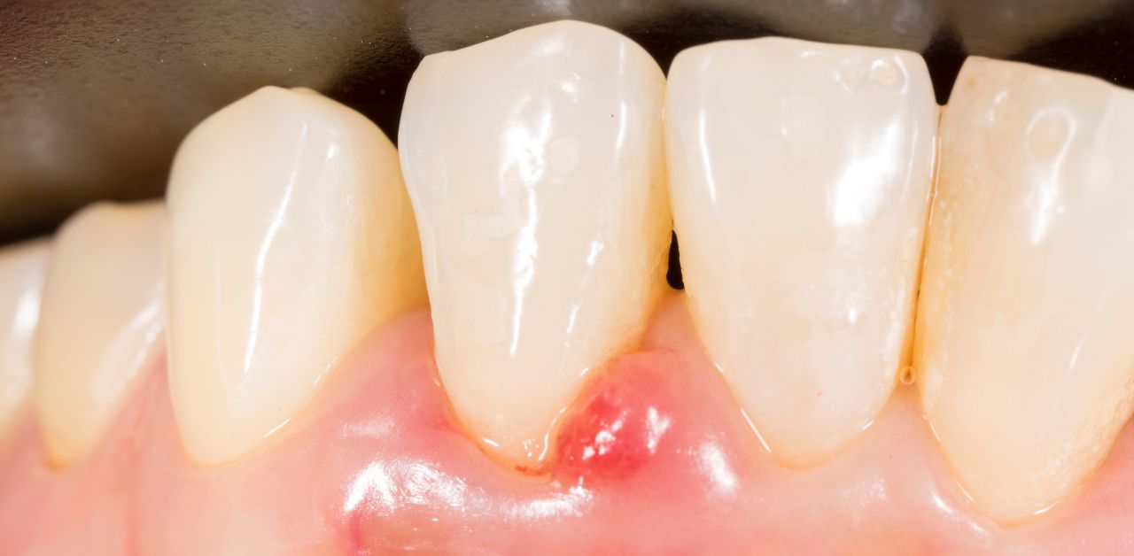 Phương pháp phòng tránh viêm chân răng có mủ