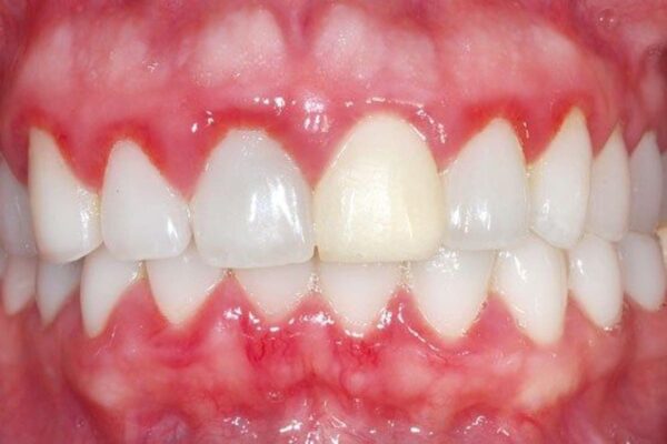 Phương pháp giúp điều trị viêm chân răng hiệu quả