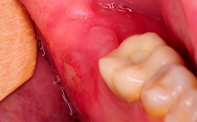 Các triệu chứng cơ bản của sưng nướu răng khôn