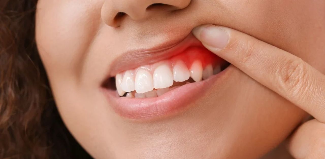 Viêm Chân Răng Có Mủ Điều Trị Như Thế Nào?