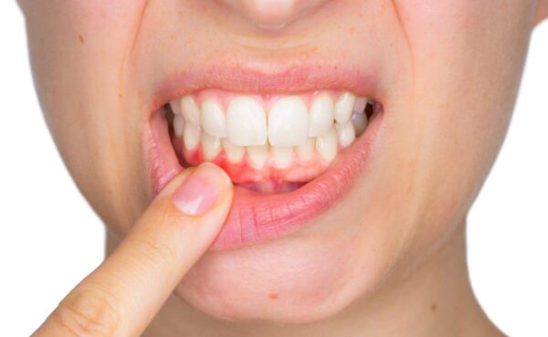 Viêm Chân Răng Là Gì? Khi Bị Viêm Chân Răng Nên Làm Gì?