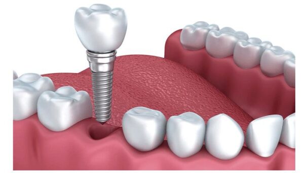 All on 4 dental implants removable?