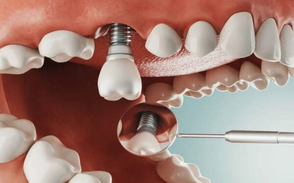 Steps in the ALL-on-6 implant procedure