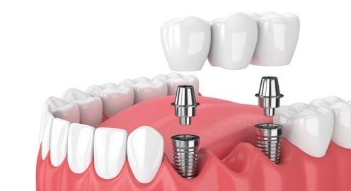 Common Problems with All-on-6 Dental Implants