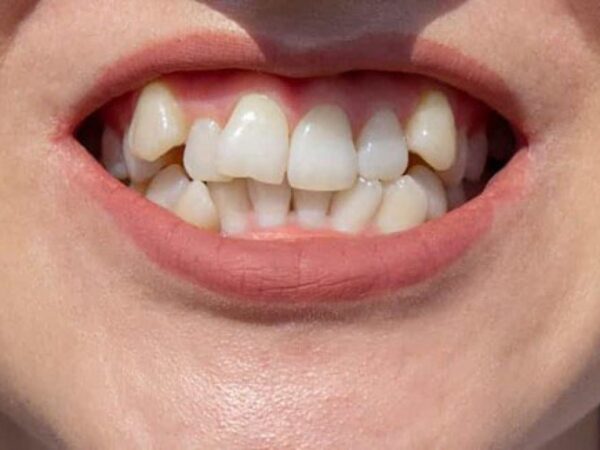 Causes of crooked teeth Causes of crooked teeth