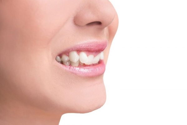 Causes of crooked teeth: The arch size is smaller than the size of the permanent teeth Causes of crooked teeth: The arch size is smaller than the size of the permanent teeth