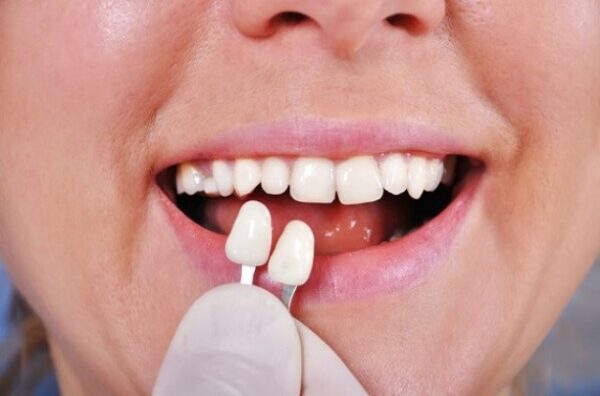 Causes of crooked teeth and Porcelain veneers for crooked teeth Causes of crooked teeth and Porcelain veneers for crooked teeth