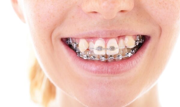 Causes of crooked teeth and the methods to cure crooked teeth Causes of crooked teeth and the methods to cure crooked teeth