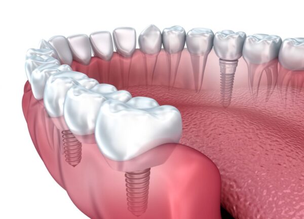 Platinum Dental implant dentist is a key decision for your implant option