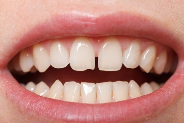 Which method is the safest and most effective way to fill a gap between teeth? Which method is the safest and most effective way to fill a gap between teeth?