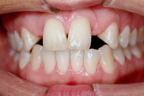 Can I fill a gap between teeth? Can I fill a gap between teeth?