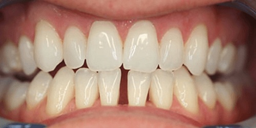 Can a dentist fill a gap between teeth? Can a dentist fill a gap between teeth?