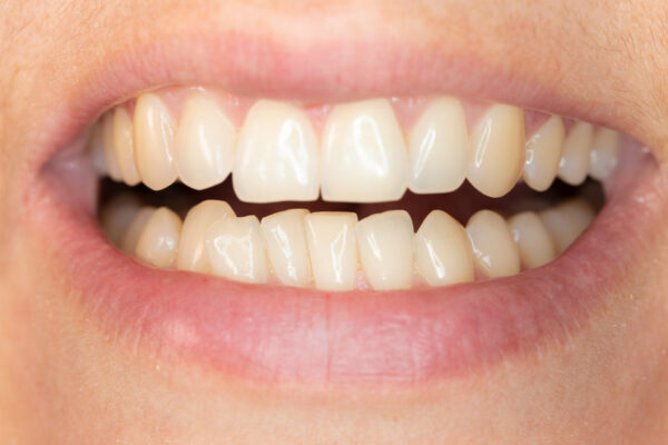 How to fix misaligned teeth? How to fix misaligned teeth?