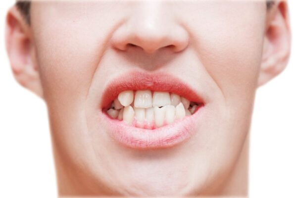 Porcelain teeth may be a viable alternative to crooked braces Porcelain teeth may be a viable alternative to crooked braces